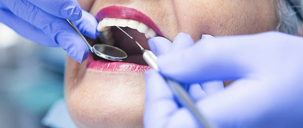 Best Knocked-Out Tooth (Avulsed Tooth) Treatment in Buckhead, GA